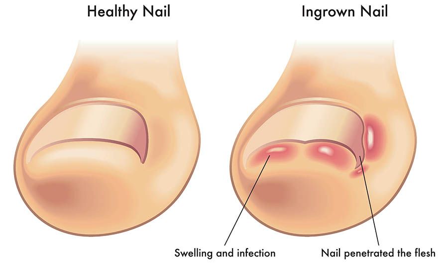 Podiatrist Glenroy
Podiatrist Coburg
Podiatrist Coburg north
Podiatrist 
Heel pain
Plantar fasciitis
Sports podiatrist
Ingrown toenail
warts
Corn
flat feet